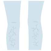 壹醫健  Dr.One 靜脈曲張 